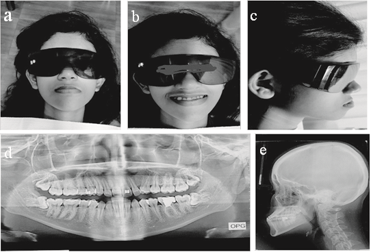 Extraoral photographs, OPG and lateral cephalogram for Case 1