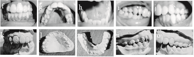 Intraoral photographs and study models for Case 2