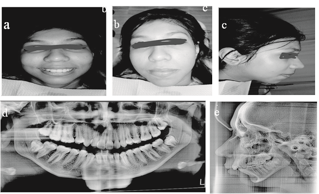 Extraoral photographs, OPG and lateral cephalogram for Case 2