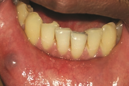 Figure 1a: Mucocele in lower lip