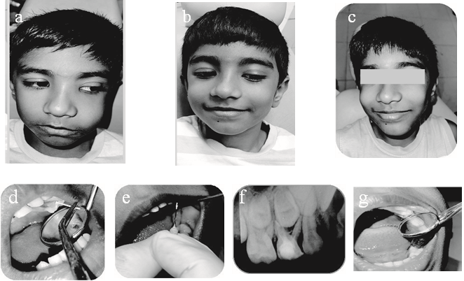 Figure-3: After calcium hydroxide